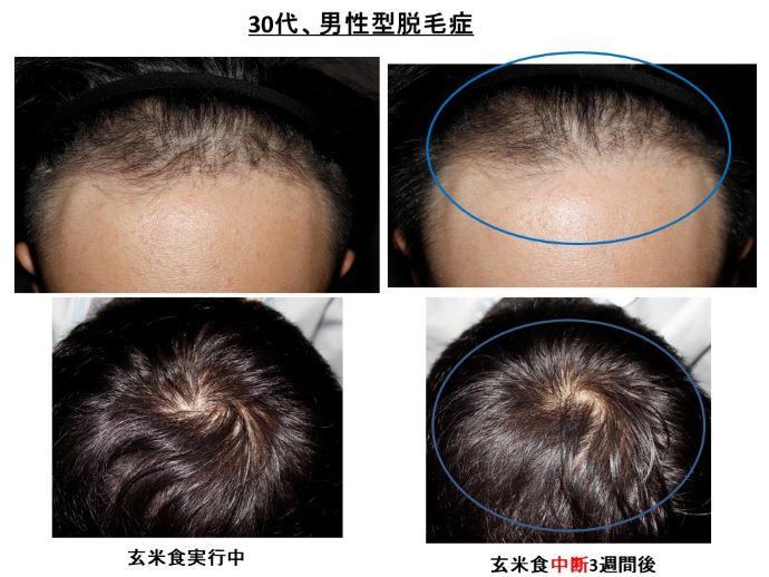 円形脱毛症　病院